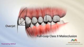 Malocclusion  Class II Div I [upl. by Tay]