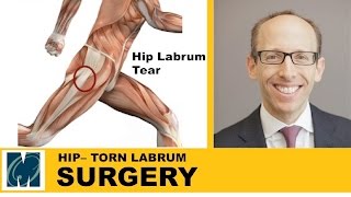 Hip Pain  Torn Labrum Hip [upl. by Jaye]