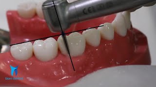 TOOTH PREPARATION FOR ZIRCONIA CROWN [upl. by Lebar]