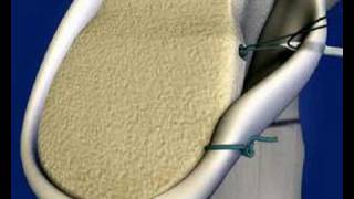 Shoulder Labral Repair [upl. by Airpal]