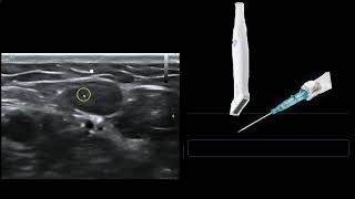 Transperineal Ultrasound  UVM Medical Center [upl. by Yarrum461]