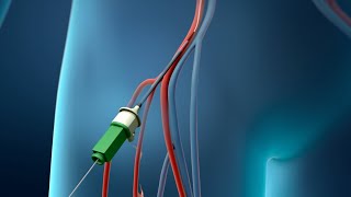 Coronary Angioplasty Femoral Access [upl. by Sirak]