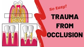 Trauma From Occlusion TFO  PERIODONTOLOGY [upl. by Garlen]