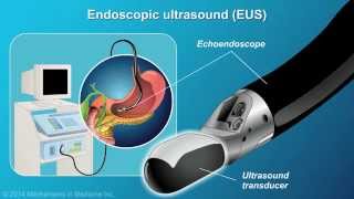 Understanding EUSFNA [upl. by Aerdnwahs]