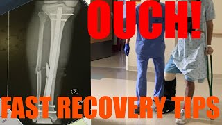 How to Recover Quickly From Broken Leg Fractured Tibia  Fibula ORIF Surgery [upl. by Torie]