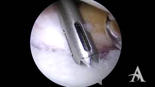 Shoulder Labral Bankart Repair Using Modern Arthroscopic Technique  Ostrander [upl. by Duax823]