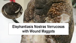 Elephantiasis Nostras Verrucosas and Wound Maggots [upl. by Anilac]