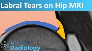 Labral Tears on Hip MRI [upl. by Valery]