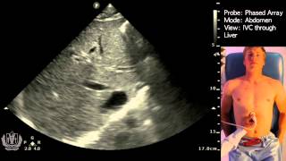 Transabdominal Pelvis Ultrasound Scanning Techniques [upl. by Daub]