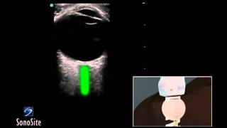 IVC Ultrasound STEP by STEP  Easiest Method [upl. by Anderson578]