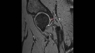 Tear of the posterior hip labrum [upl. by Selemas]