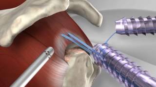 Knotless Rotator Cuff Repair with Arthrex® SpeedFix™ [upl. by Geordie]